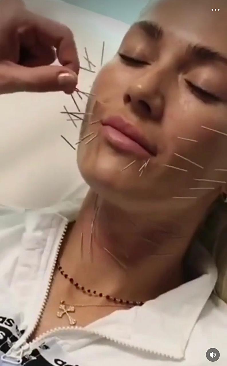 Needle Shaping 1